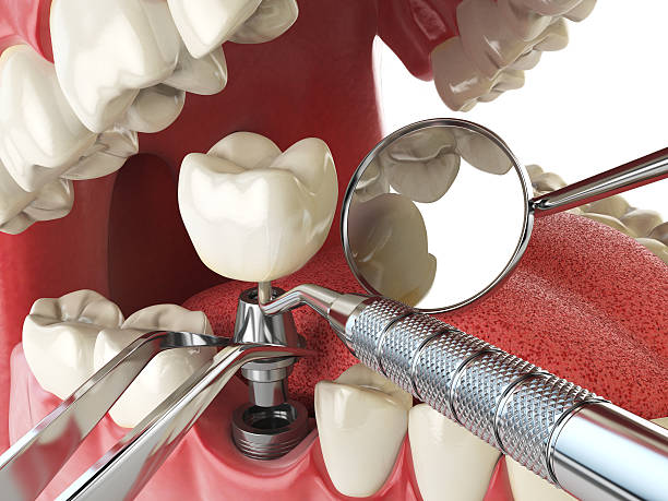 Best Emergency Tooth Extraction in Windsor, CA